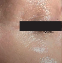 Eye + After