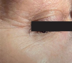 Eye + Before